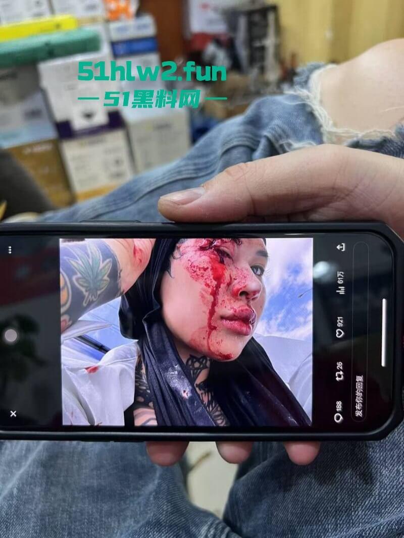 卖惨惯犯纹身妹，骑电瓶车出车祸惨遭破相朋友圈无奈卖身求钱就医，骚货的卖身已成习惯。-7