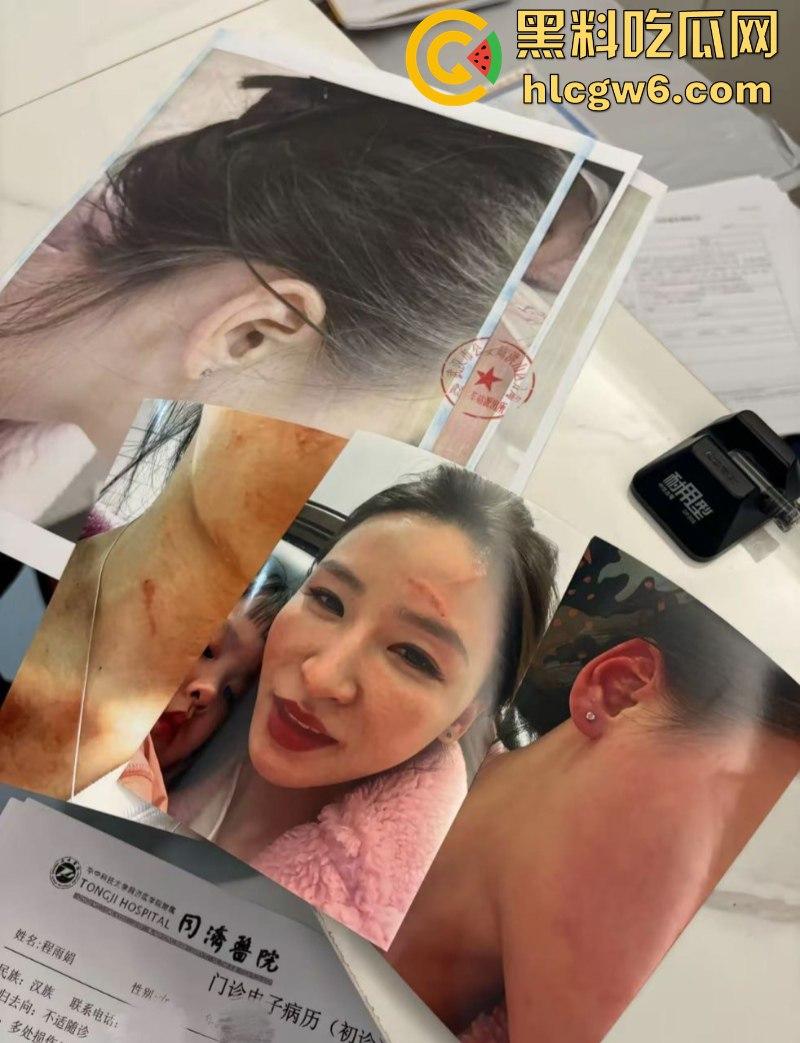 湖北一小学美女老师抖音自曝离婚探女遭前夫爹殴打抓脸全身多处受伤 伤情实拍曝光!都是血口子-1