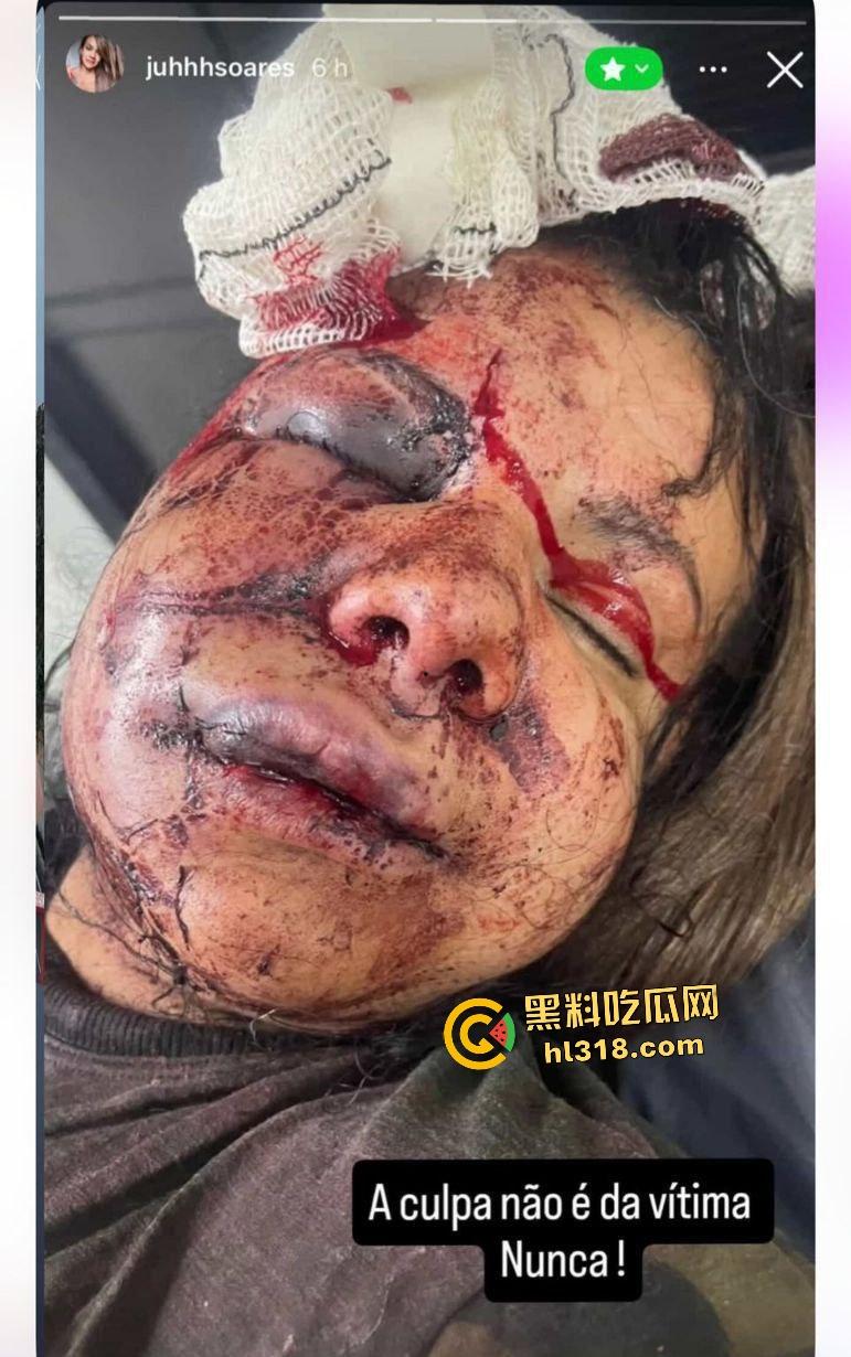 巴西前篮球明星伊戈尔·卡布拉尔化身暴徒！电梯内狂殴女友60拳，面骨粉碎血溅当场！-8