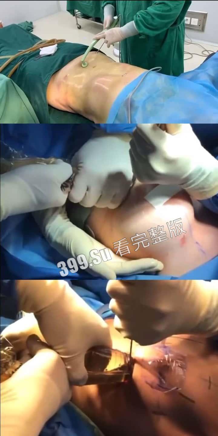 医美整形那些事儿 假的真不了 看的脸皮发麻 (三)-2