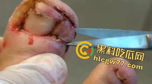患者天天啃脚指甲狂得甲沟炎！帕尔米耶里手术刀下血肉狂飙，操刀医生差点呕吐！-2