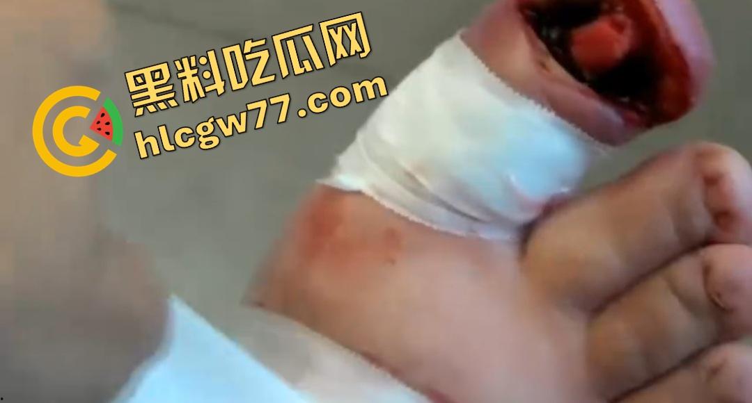 患者天天啃脚指甲狂得甲沟炎！帕尔米耶里手术刀下血肉狂飙，操刀医生差点呕吐！-5