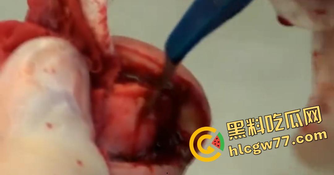 患者天天啃脚指甲狂得甲沟炎！帕尔米耶里手术刀下血肉狂飙，操刀医生差点呕吐！-6